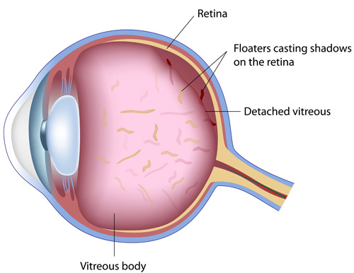 Vitreous Detachment